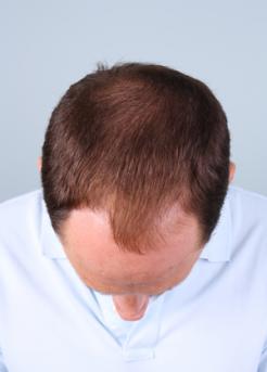 After Hair Transplant&nbsp;Midscalp